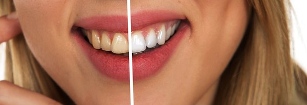 white-teeth-home-remedies